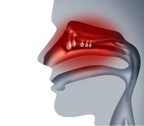 Почему у взрослых чаще рецидивируют полипы носа